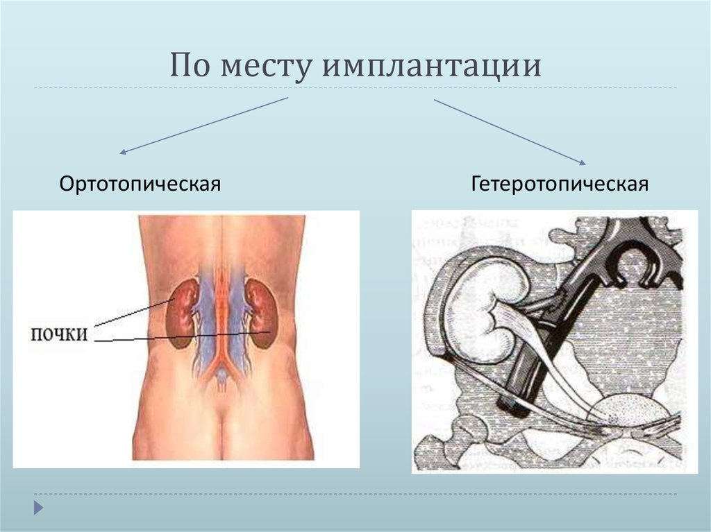 Трансплантация почки схема