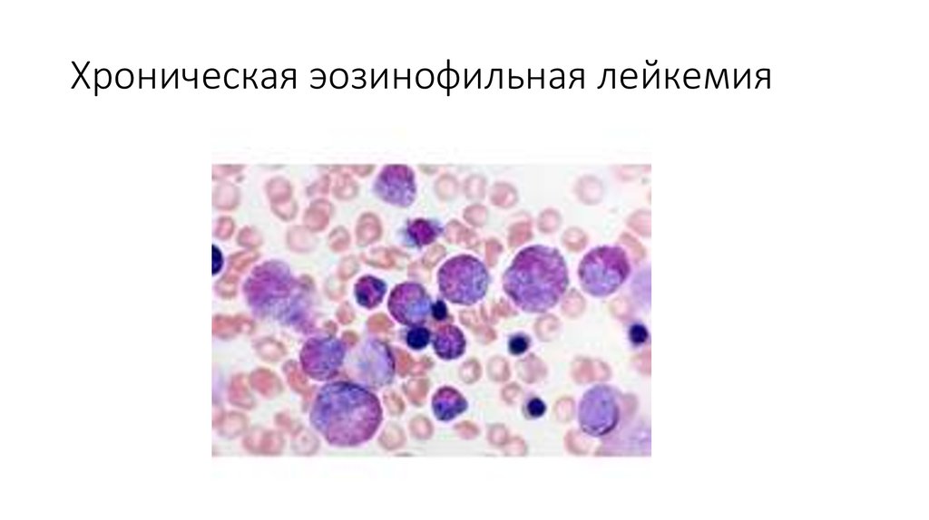 Хронические миелопролиферативные заболевания презентация