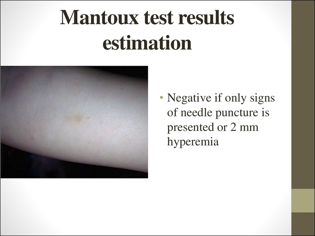 bruise positive bruise normal negative tb test pictures