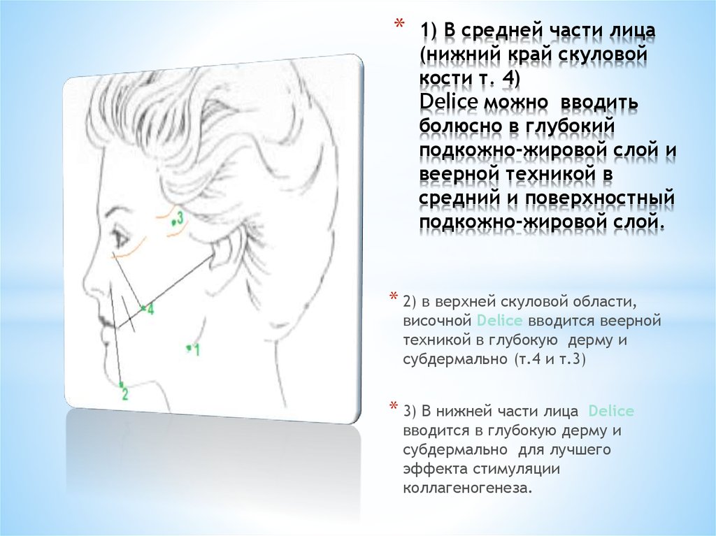 1) В средней части лица (нижний край скуловой кости т. 4) Delice можно вводить болюсно в глубокий подкожно-жировой слой и веерной техникой в сред