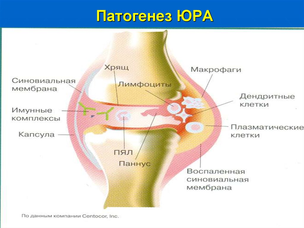 Ревматоидный артрит схема