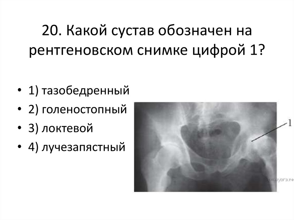 Какой сустав изображен. Какой сустав обозначен на рентгеновском снимке. Какой сустав обозначен на рентгеновском снимке цифрой 1. Обозначения на рентгеновском снимке. Обозначение стороны на рентгенограммах.