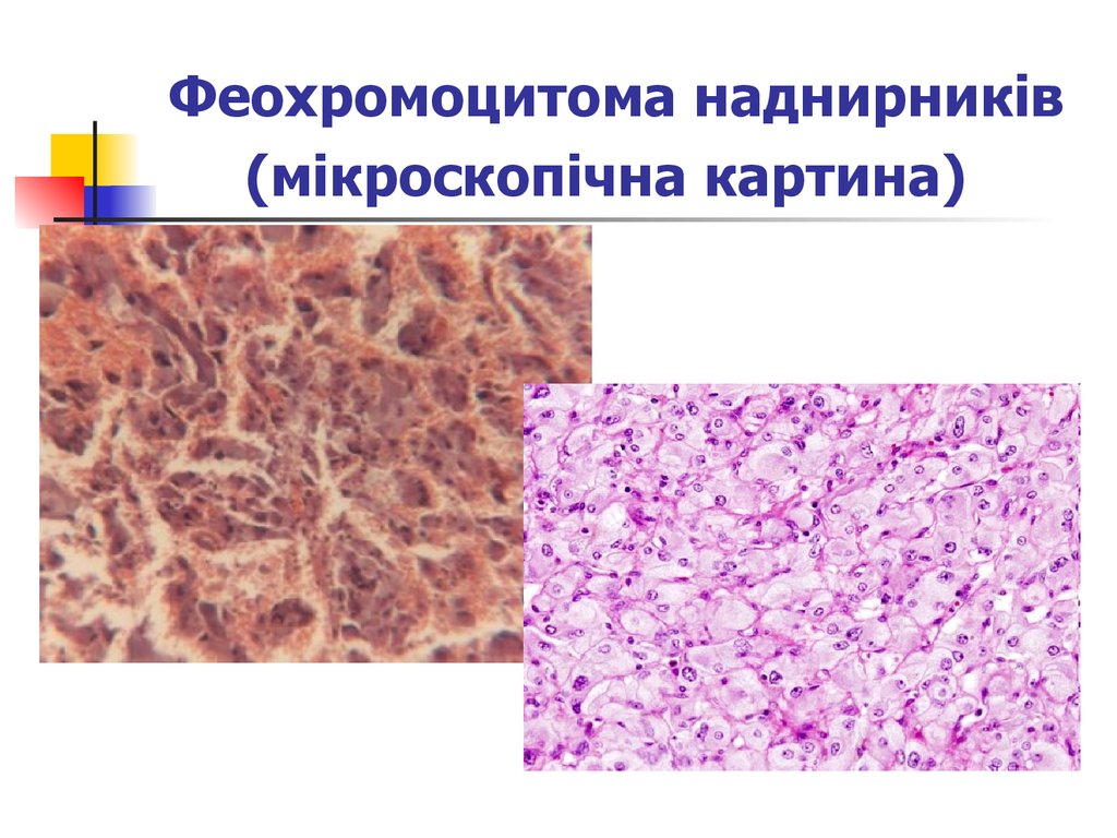 Феохромоцитома наднирників (мікроскопічна картина)