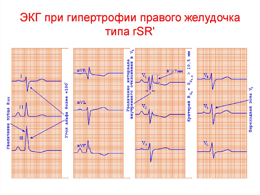 Гипертрофия левого и правого желудочка. Гипертрофия правого желудочка типа RSR. S Тип гипертрофии правого желудочка. S Тип гипертрофии правого желудочка на ЭКГ. Гипертрофия правого желудочка на ЭКГ.