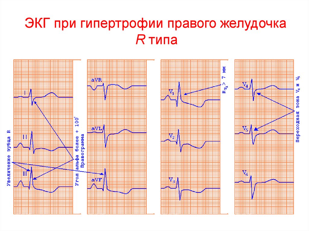 Поворот сердца правым желудочком вперед что это. Гипертрофия правого желудочка типа RSR. S Тип гипертрофии правого желудочка. Правожелудочковая гипертрофия ЭКГ. Гипертрофия желудочков на ЭКГ.