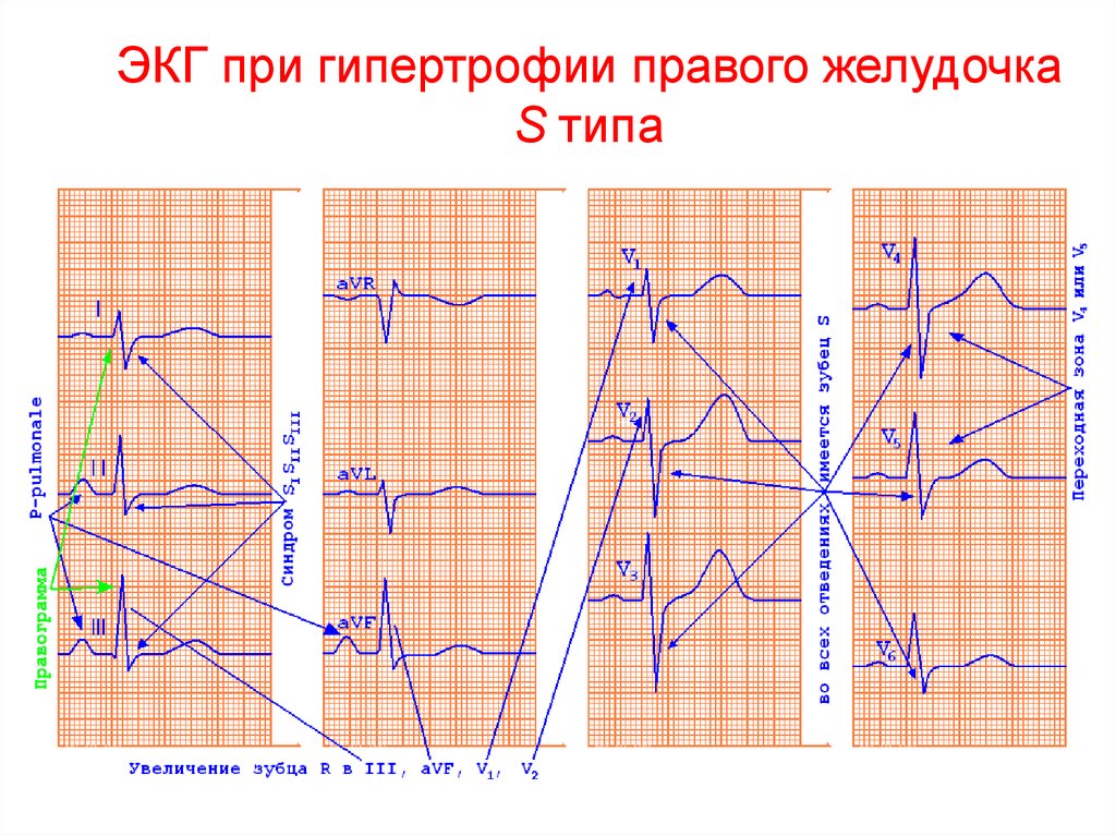 Гипертрофия правого желудочка на экг. S Тип гипертрофии правого желудочка на ЭКГ. ЭКГ В 12 отведениях гипертрофия правого желудочка. Типы гипертрофии правого желудочка на ЭКГ.