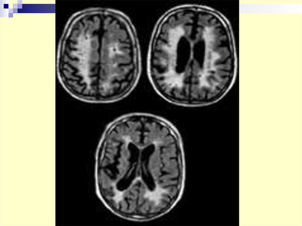 Дистрофические дисциркуляторные изменения мозга. Дисциркуляторная энцефалопатия головного мозга на кт. Лейкоареоз головного мозга на кт. Острая гипертоническая энцефалопатия мрт. Дисциркуляторная энцефалопатия лейкоареоз.