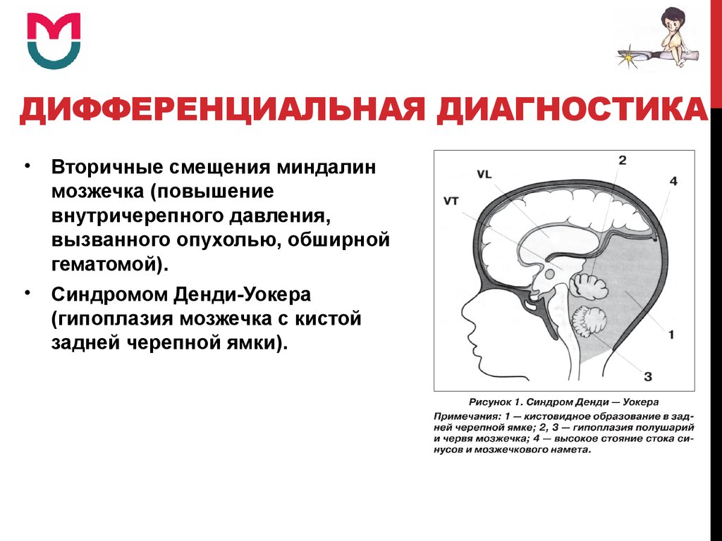 Гипоплазия поперечных синусов головного мозга