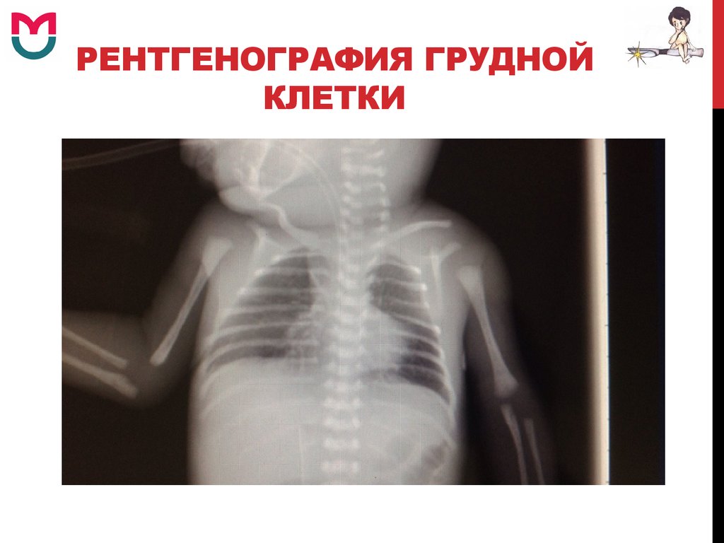Делают рентген грудной клетки ребенку. Рентгеноскопия грудной клетки. Рентгенология грудной клетки. Рентгенография грудины. Рентгенограмма грудной клетки.