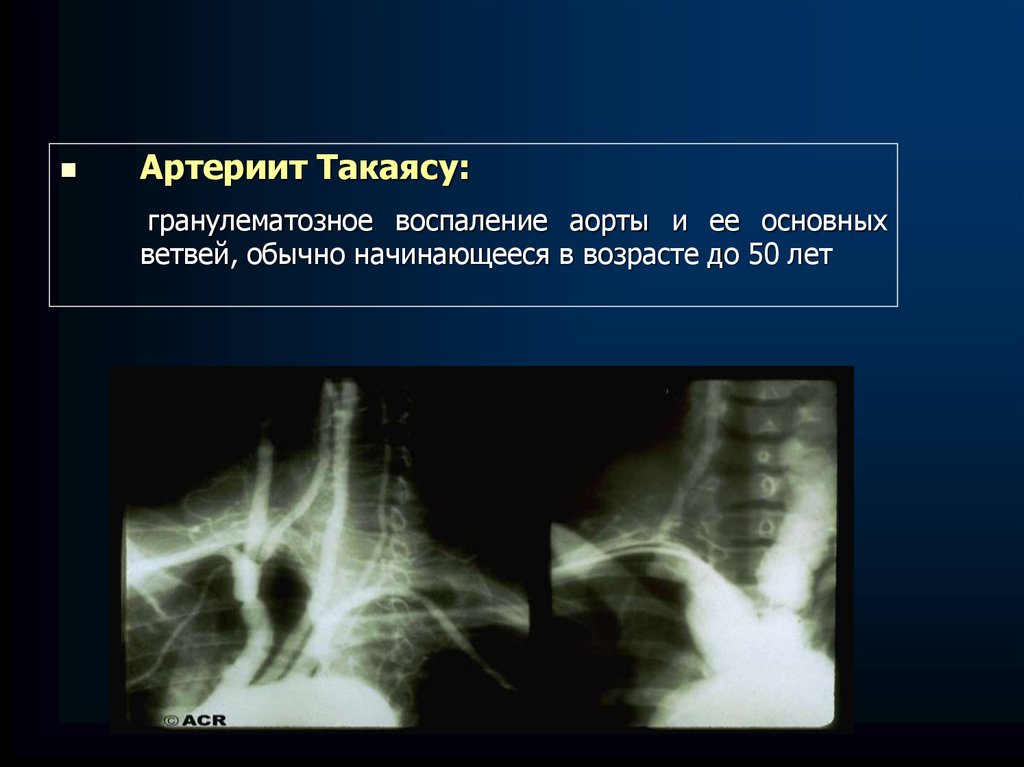 Артериит такаясу презентация