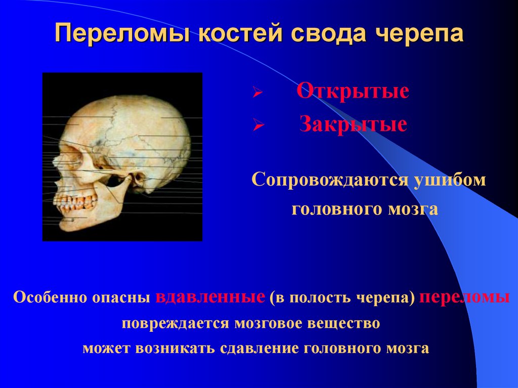 Переломы костей свода черепа