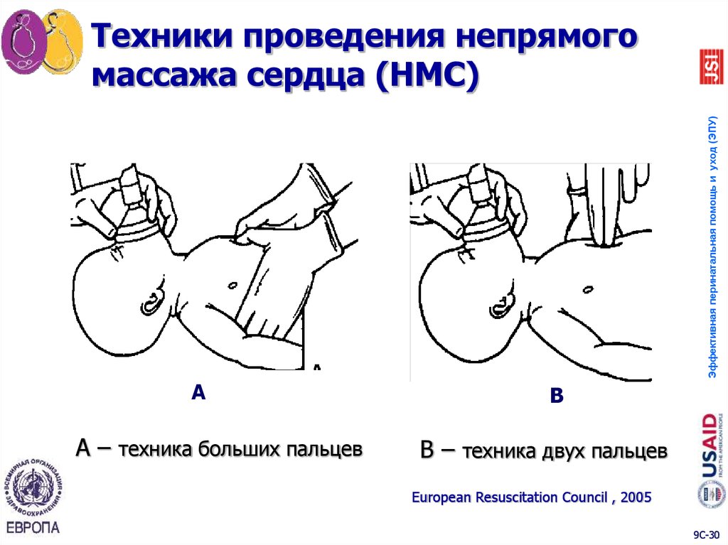 Схема массажа сердца непрямого