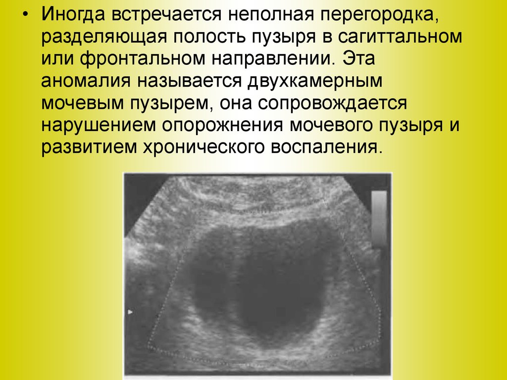 Неполное опорожнение мочевого у мужчины. УЗИ мочевого пузыря при хроническом цистите. Перегородка в мочевом пузыре. Перегородка в мочевом пузыре на УЗИ. Лейкоплакия мочевого пузыря на УЗИ.