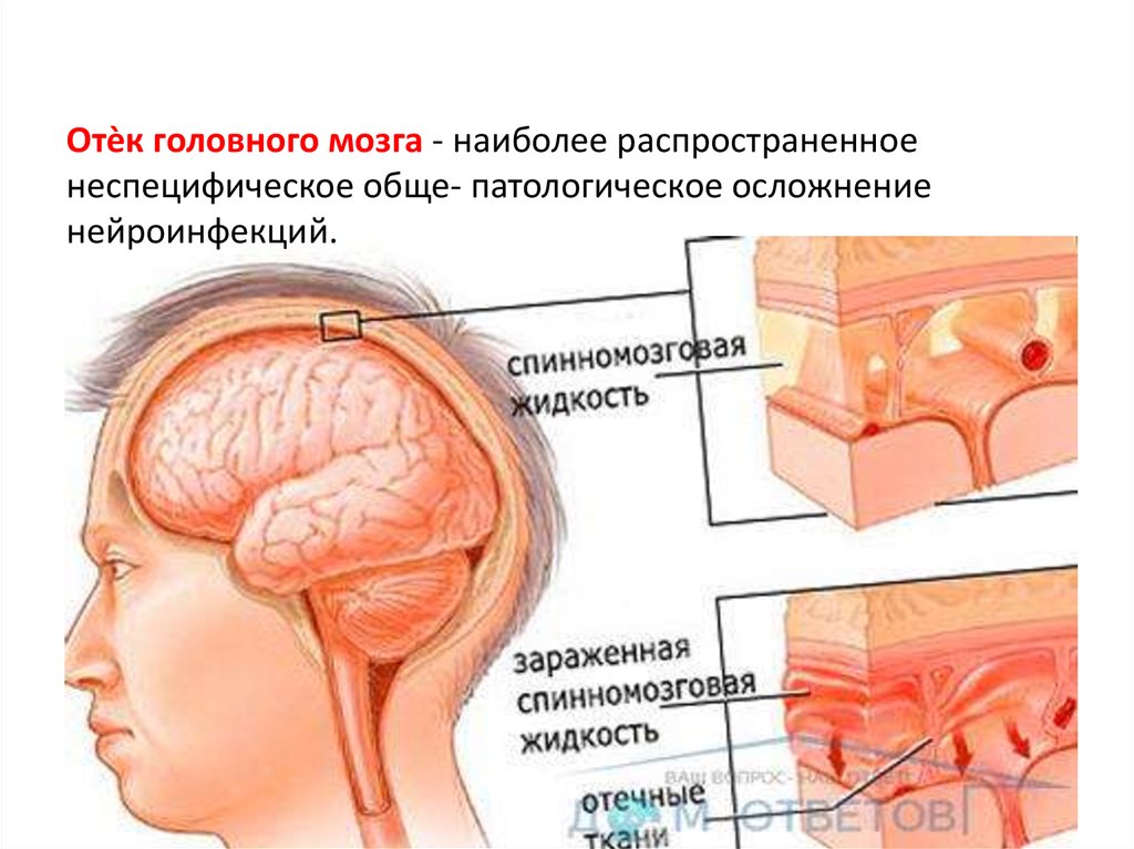 Отек головного мозга последствия у взрослого. Отек набухание головного мозга. Отек и набухание вещества головного мозга. Отёк и набухание головного мозга.