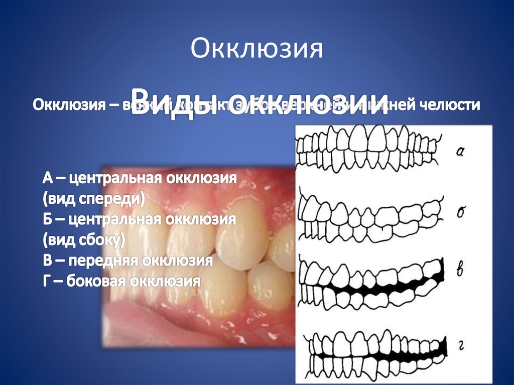 Виды прикуса. Артикуляция окклюзия и прикус зубов. Центральная окклюзия. Окклюзия это в стоматологии. Передняя окклюзия зубных рядов.