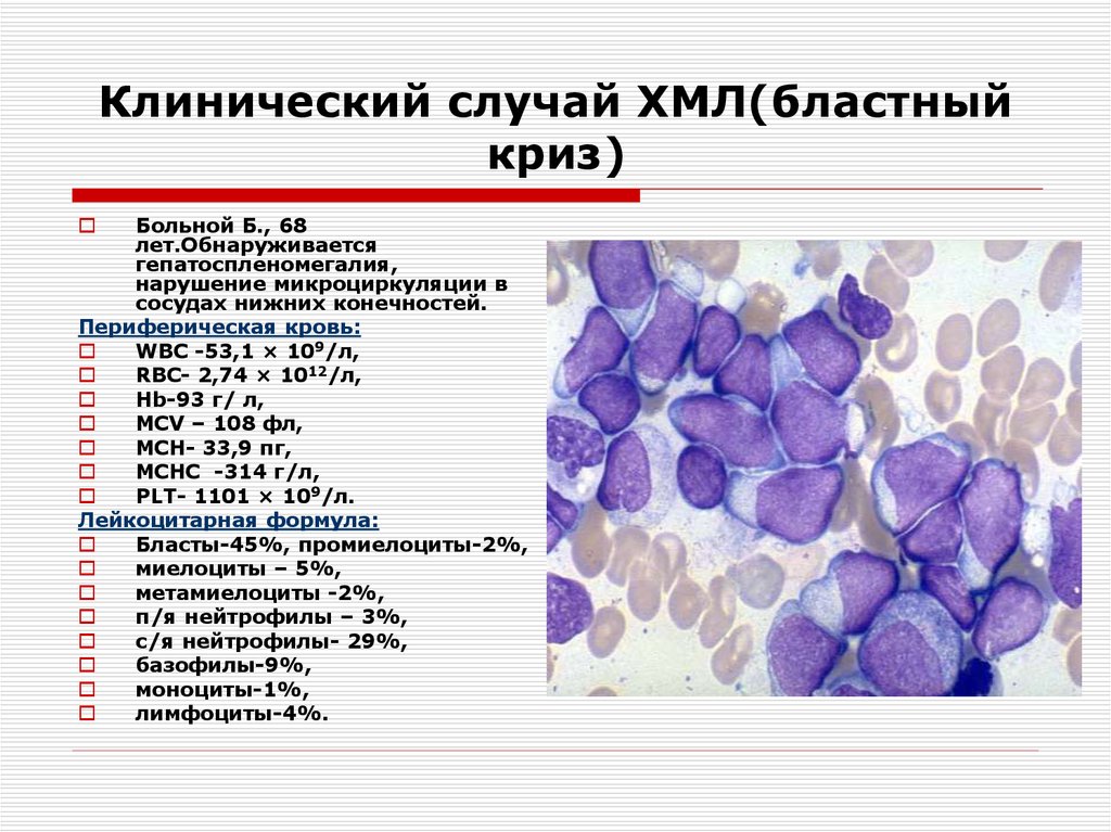 Хронический миелолейкоз клиническая картина