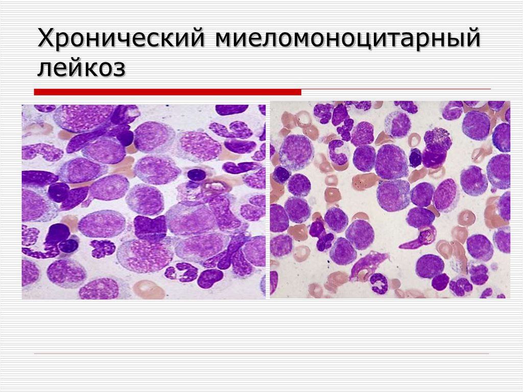 Хмл сайт. Хронический миеломоноцитарный лейкоз картина крови. Острый миелобластный лейкоз гистология. Хронический миеломоноцитарный лейкоз гистология. Хронический миелоидный лейкоз гистология.