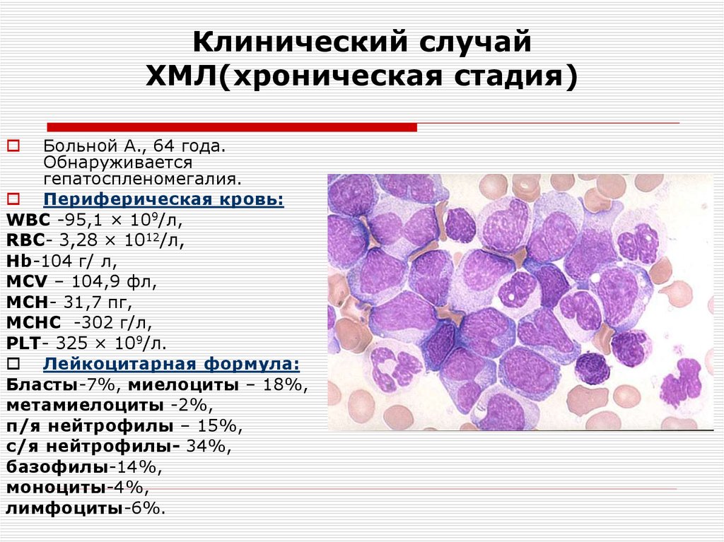 Селезенка лимфоциты. Хронический миелолейкоз картина крови. Хронический миелобластный лейкоз гистология. Хронический моноцитарный лейкоз (ХМЛ).