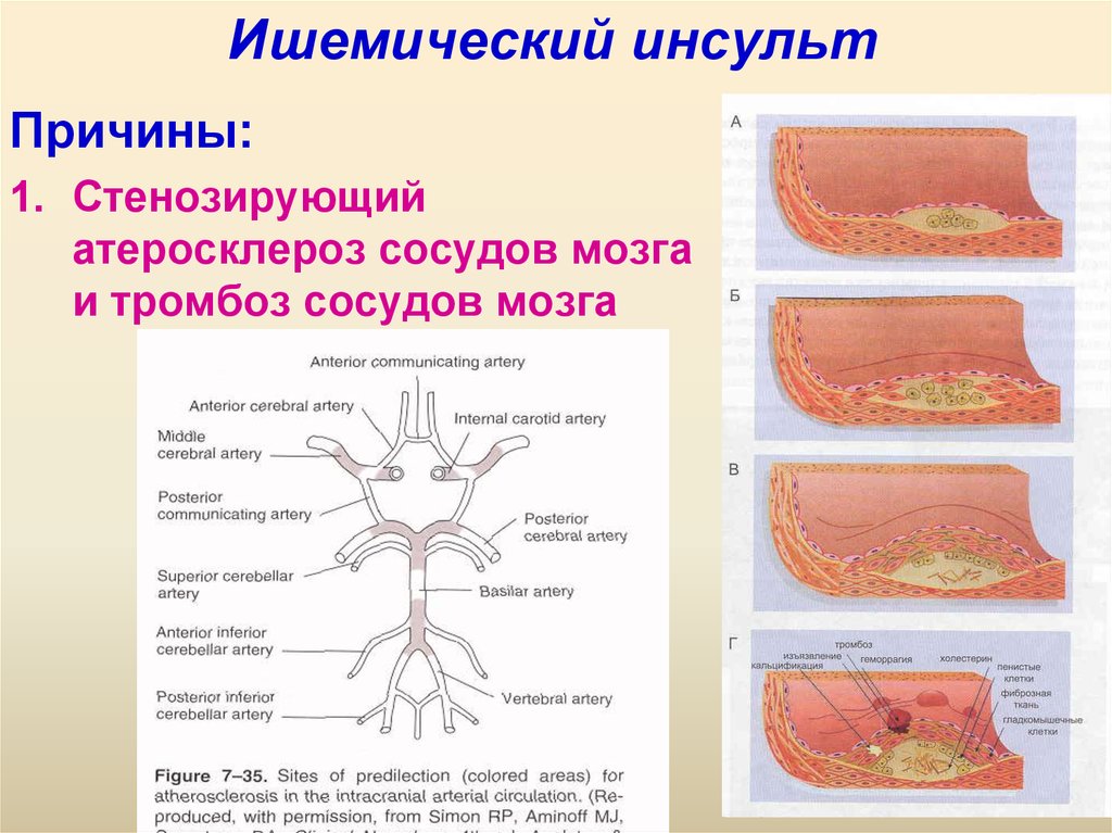 Тромбоз мозговых сосудов. Стенозирующий атеросклероз. Стенозирующий атеросклероз артерий. Стенозирующий атеросклероз стадии. Атеросклероз мозговых артерий.
