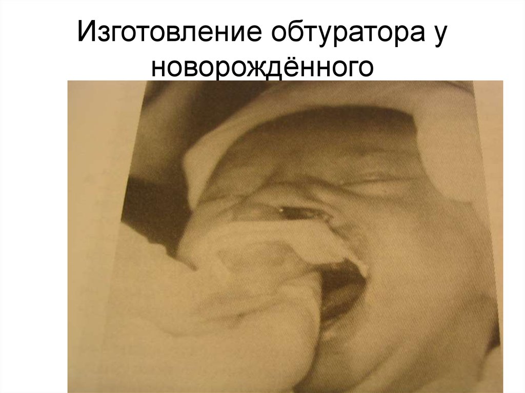 Изготовление обтуратора у новорождённого