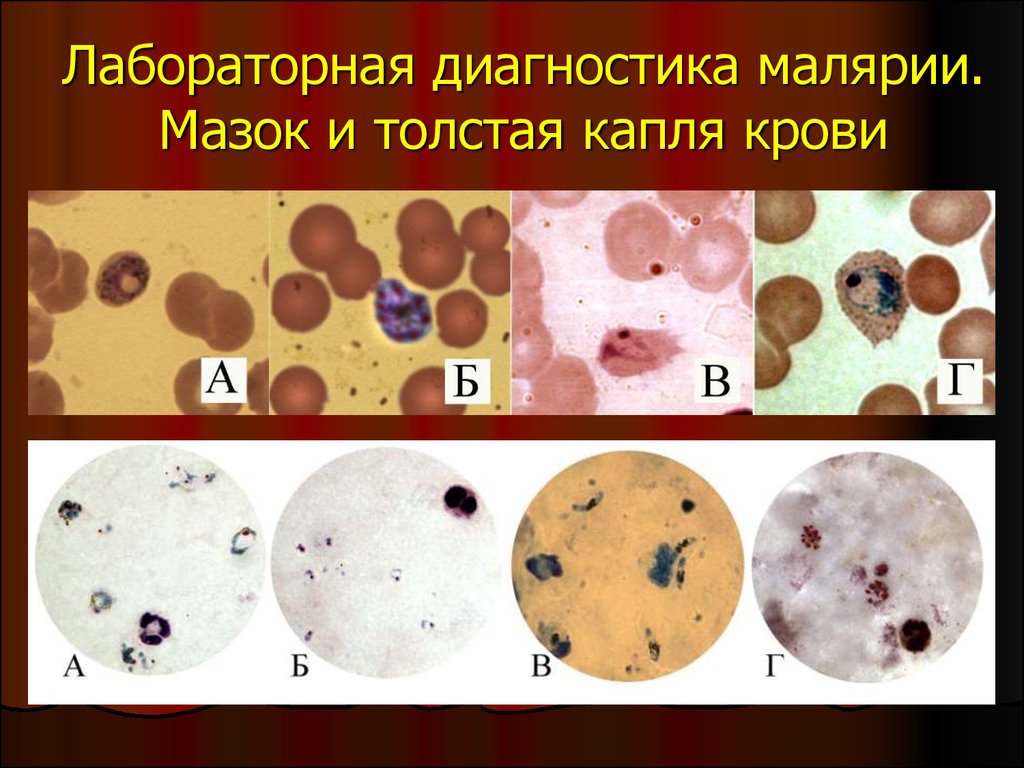 Малярия обследование. Малярийный плазмодий мазок крови. Лабораторная диагностика малярийного плазмодия. Малярия кровь микроскопия. Малярийный плазмодий толстая капля.