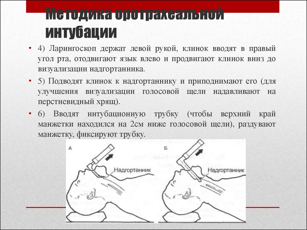 Интубация трахеи презентация