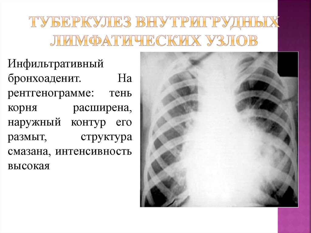 туберкулез внутригрудных лимфатических узлов
