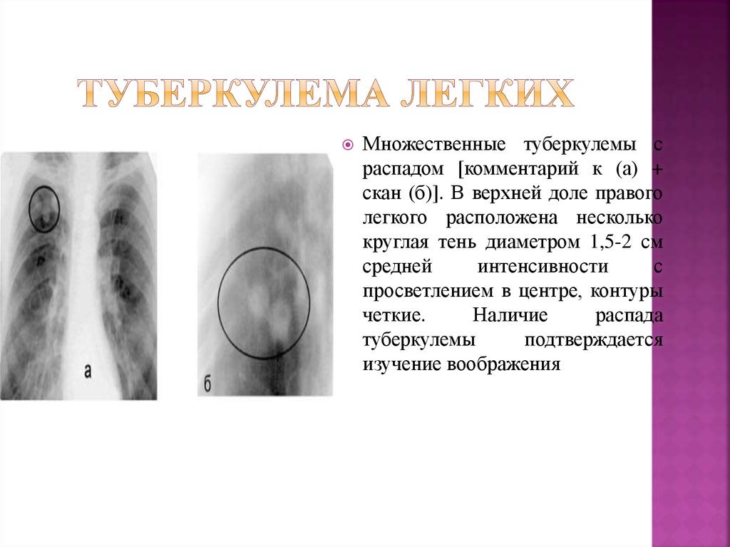 Туберкулема. Гомогенная туберкулема. Солитарная туберкулема легкого. Солитарная туберкулема строение. Солитарная слоистая туберкулема.