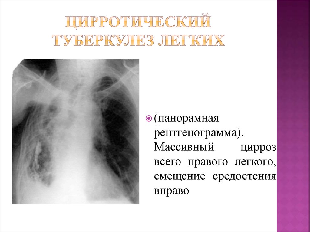 Цирротический туберкулез легких рисунок