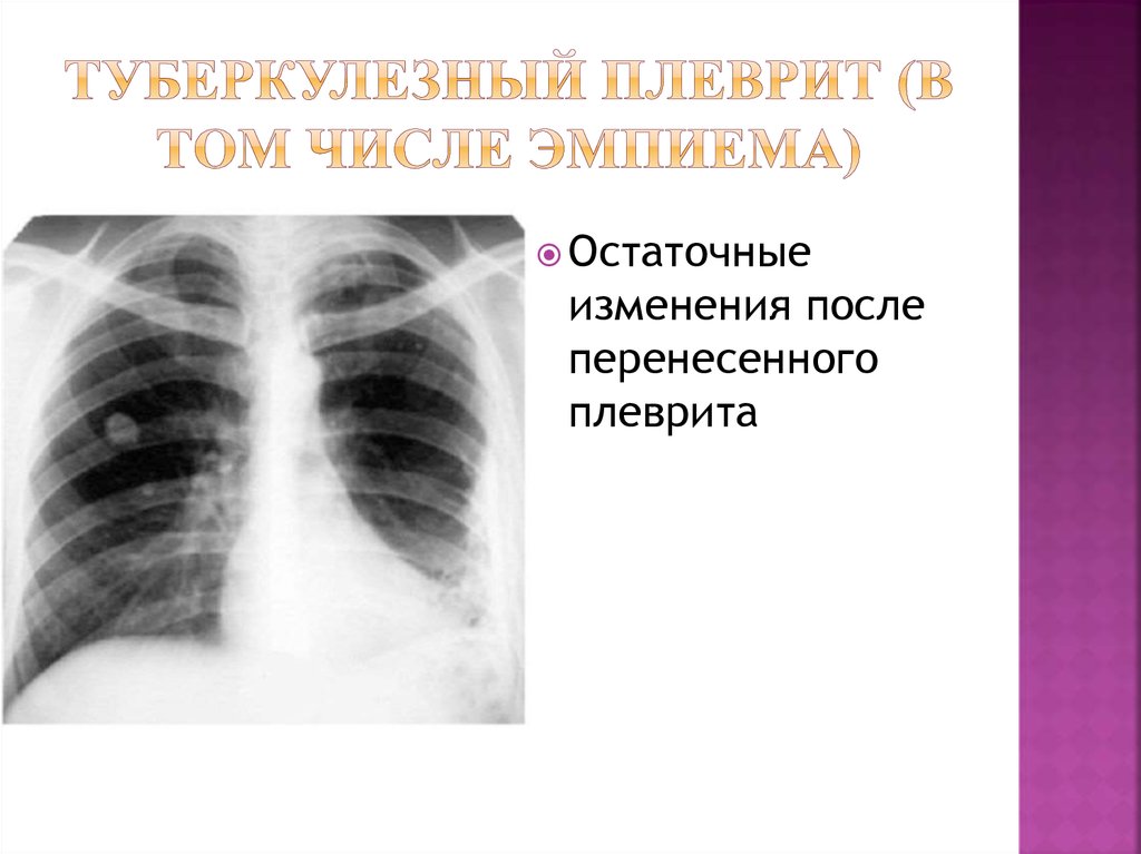 туберкулезный плеврит (в том числе эмпиема)