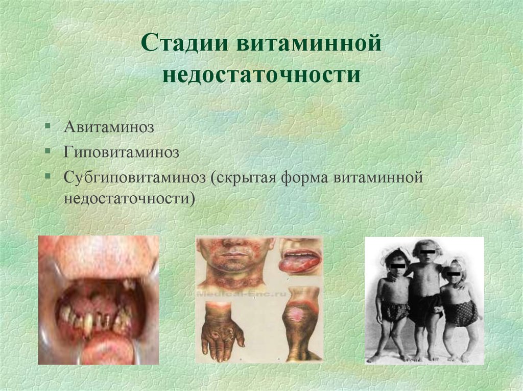 Стадии витаминной недостаточности