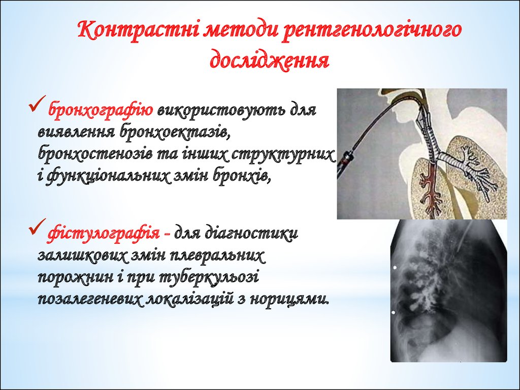 Методы легких. Контрастные методы исследования. Рентгенологические контрастные методы исследования. Контрастные методы рентгеновского исследования. Контрастные методы исследования в рентгенологии.