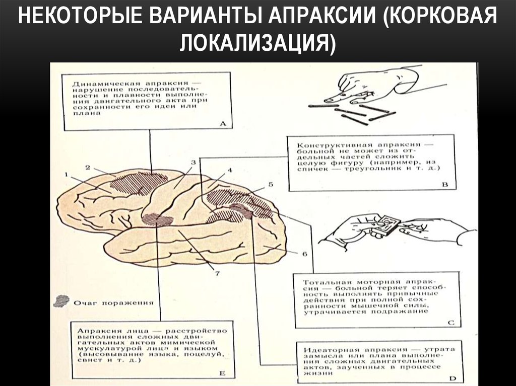 Поражения корково мозга. Локализация поражений при апраксии. Мозговая локализация очага поражения при апраксии. Кинетическая апраксия при афазии. Локализация апраксий Лурия.