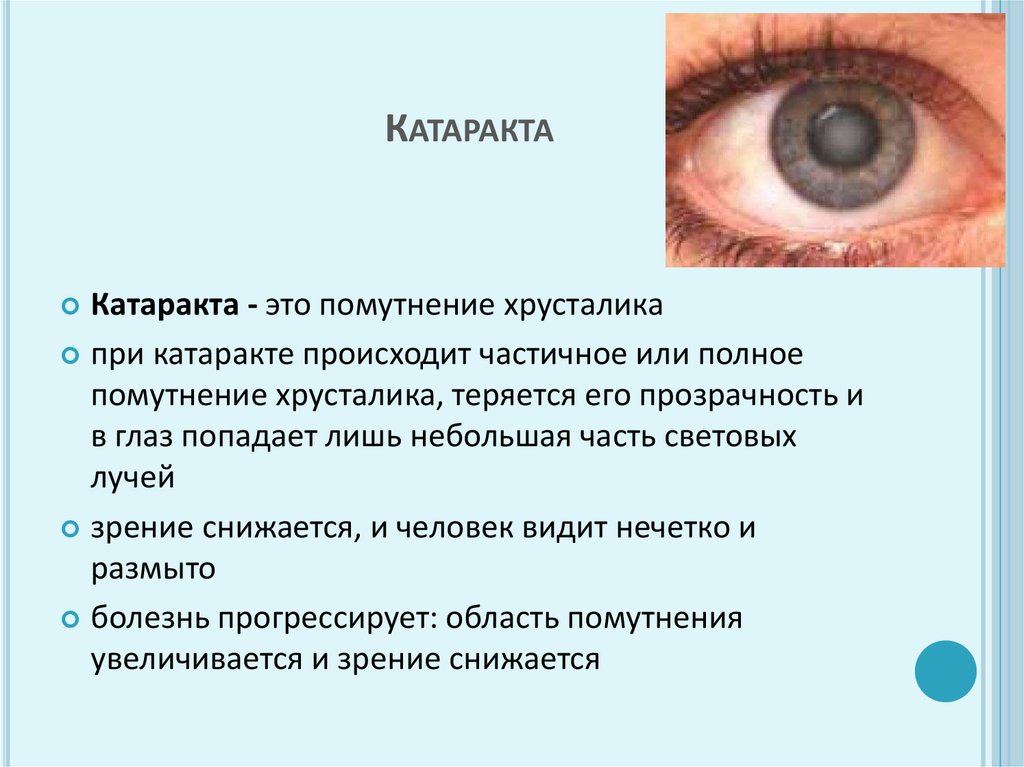 Глаз не стал видеть. Катаракта – помутнение хрусталика глаза.. Катаракта глаза симптомы причины. Катаракта - симптомы, причины и профилактика.