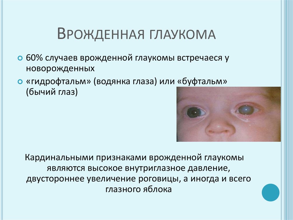 Наследственные заболевания зрения. Врожденная глаукома буфтальм. Причины развития врожденной глаукомы. Признак врожденной глаукомы у новорожденного. Врожденная глаукома признаки.