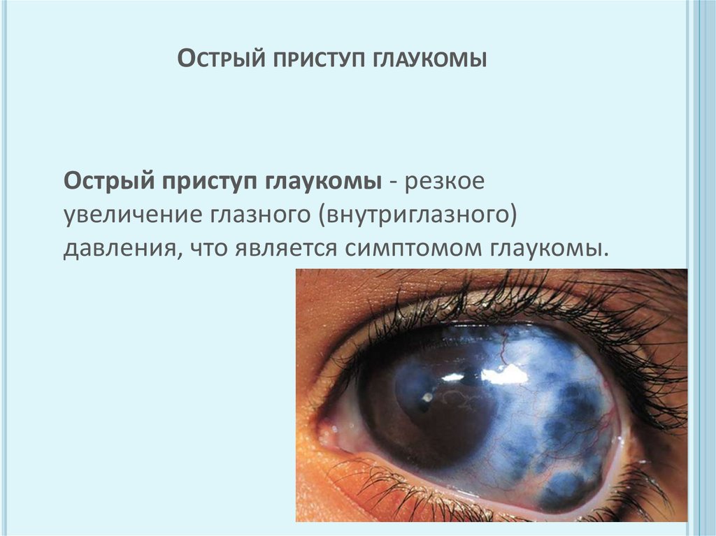 Давление в глазах симптомы. Приступ открытоугольной глаукомы симптомы. Отстрвй присьуп гдаукоиаю. Острый пристуап локуума. При остром приступе глаукомы внутриглазное давление:.