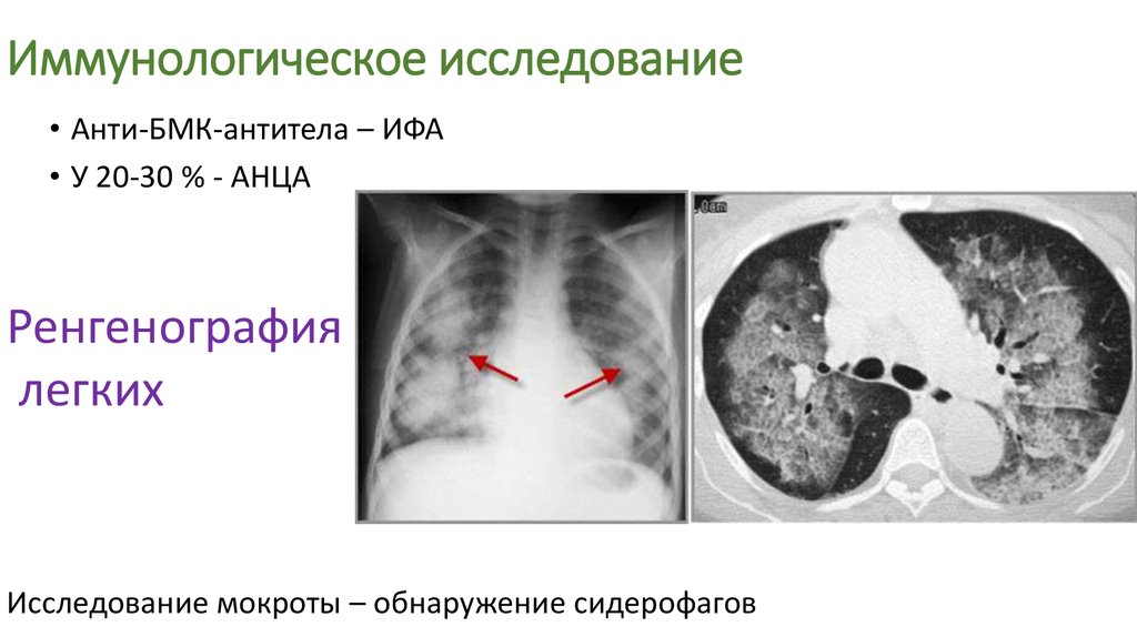 Синдром гудпасчера презентация