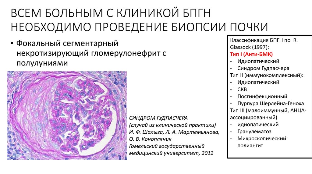 Синдром гудпасчера презентация