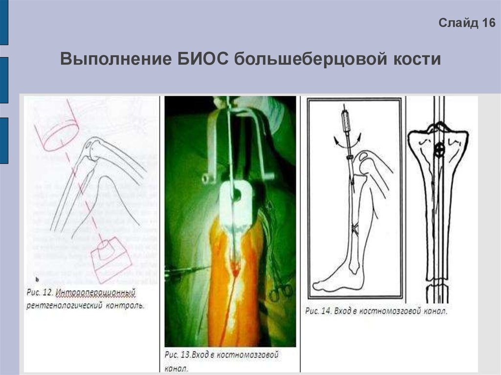 Ультразвуковой остеосинтез презентация