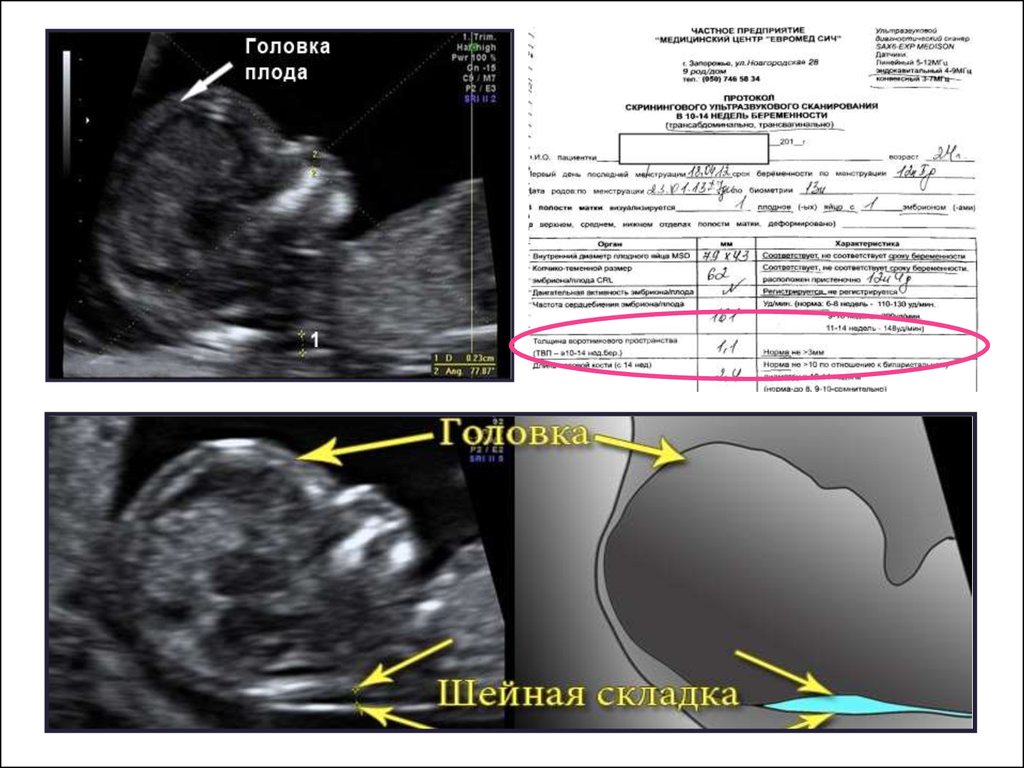 Толщина шейной складки. УЗИ шейной складки. Шейная складка у плода. Шейная складка на УЗИ плода. Шейная складка норма.