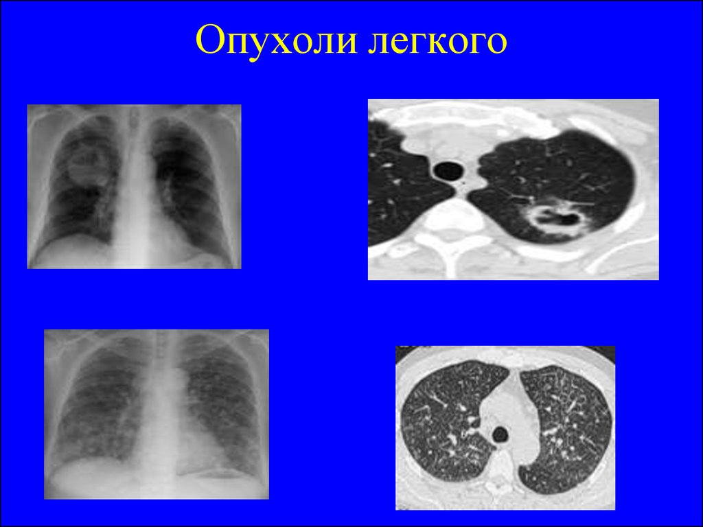 Опухоль легких. Новообразование в легких. Злокачественные образования в легких. Объемное образование легкого.