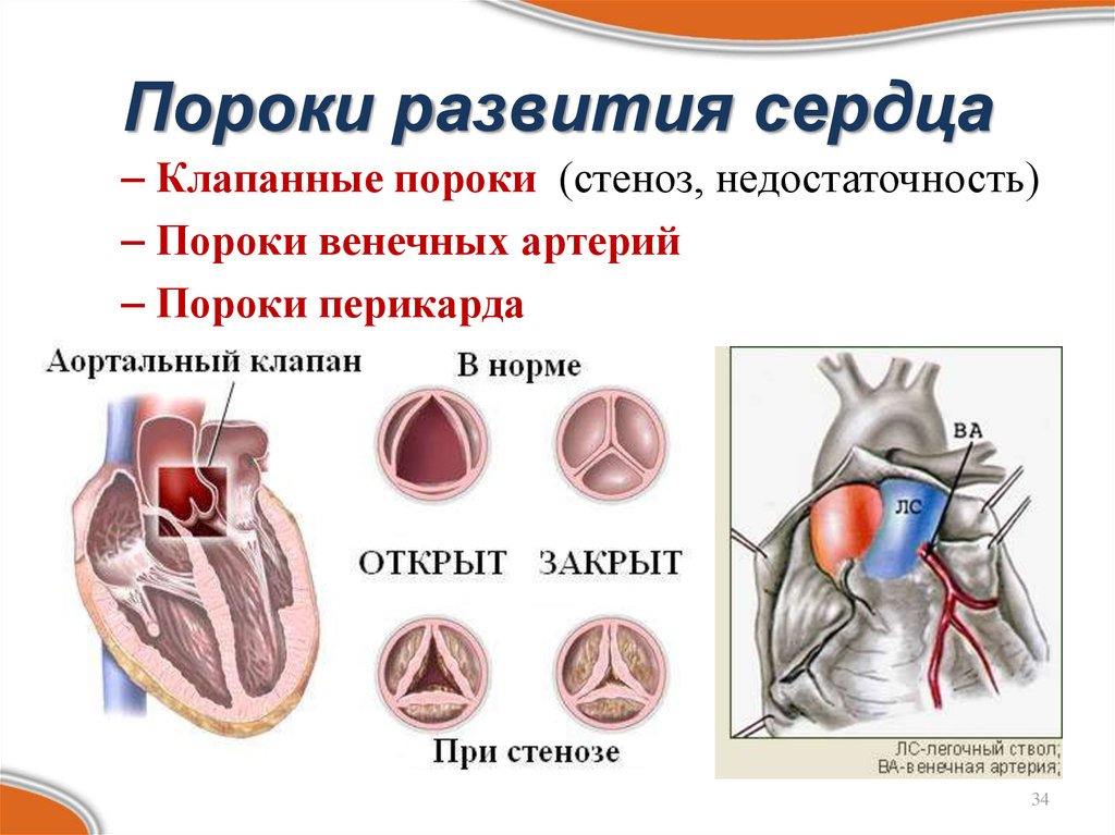 Порог сердца что это. Клапанные пороки стеноз недостаточность. Приобретенные пороки сердца морфология. Врожденные клапанные пороки сердца. Пороки сердца стенозы клапанов недостаточность клапанов.