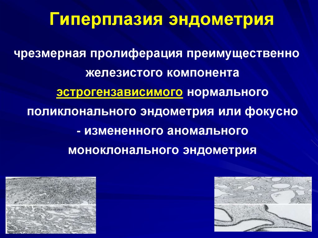 Гиперплазия эндометрия. Типы гиперплазии эндометрия. Гиперпластические процессы эндометрия патогенез. Гиперплазия эндометрия презентация.