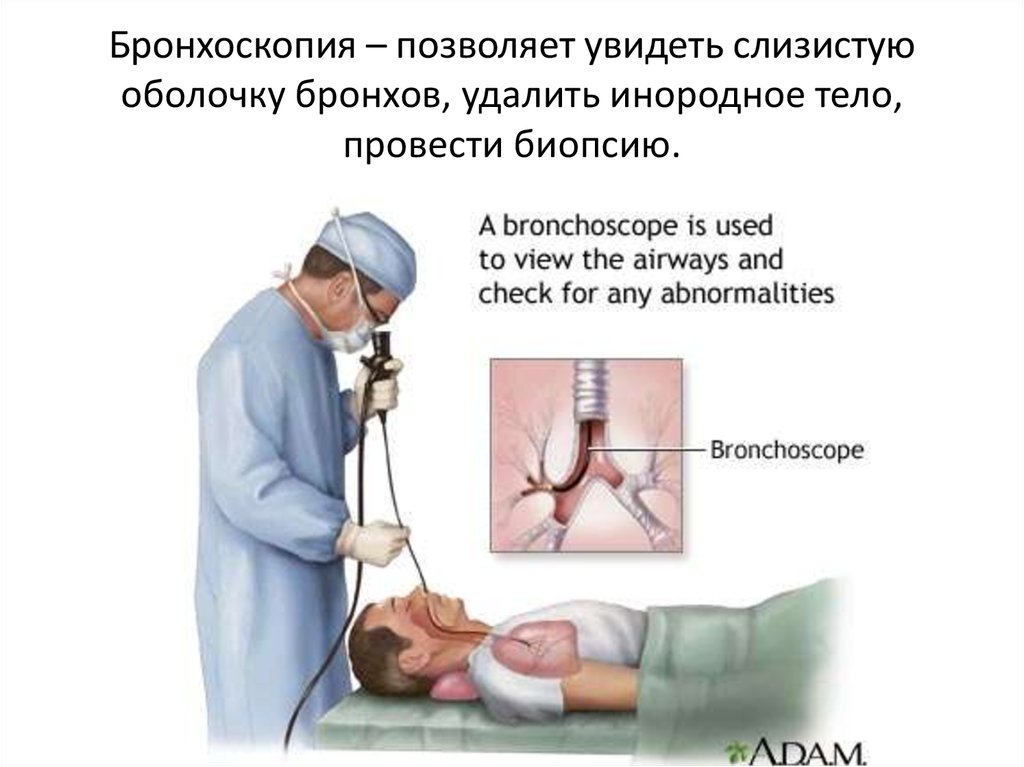 После биопсии легкого. Бронхоскопия и бронхография. Фибробронхоскопия с биопсией. Санационная бронхоскопия. Ателектаз бронхоскопия.