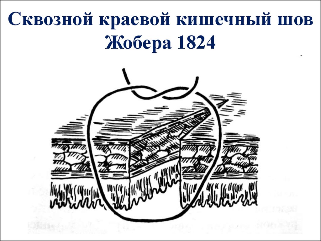 Кишечный шов. Сквозной краевой кишечный шов Жобера. Краевой Узловой шов Жобера. Сквозные непрерывные кишечные швы. Кишечный шов Альберта-Жобера.