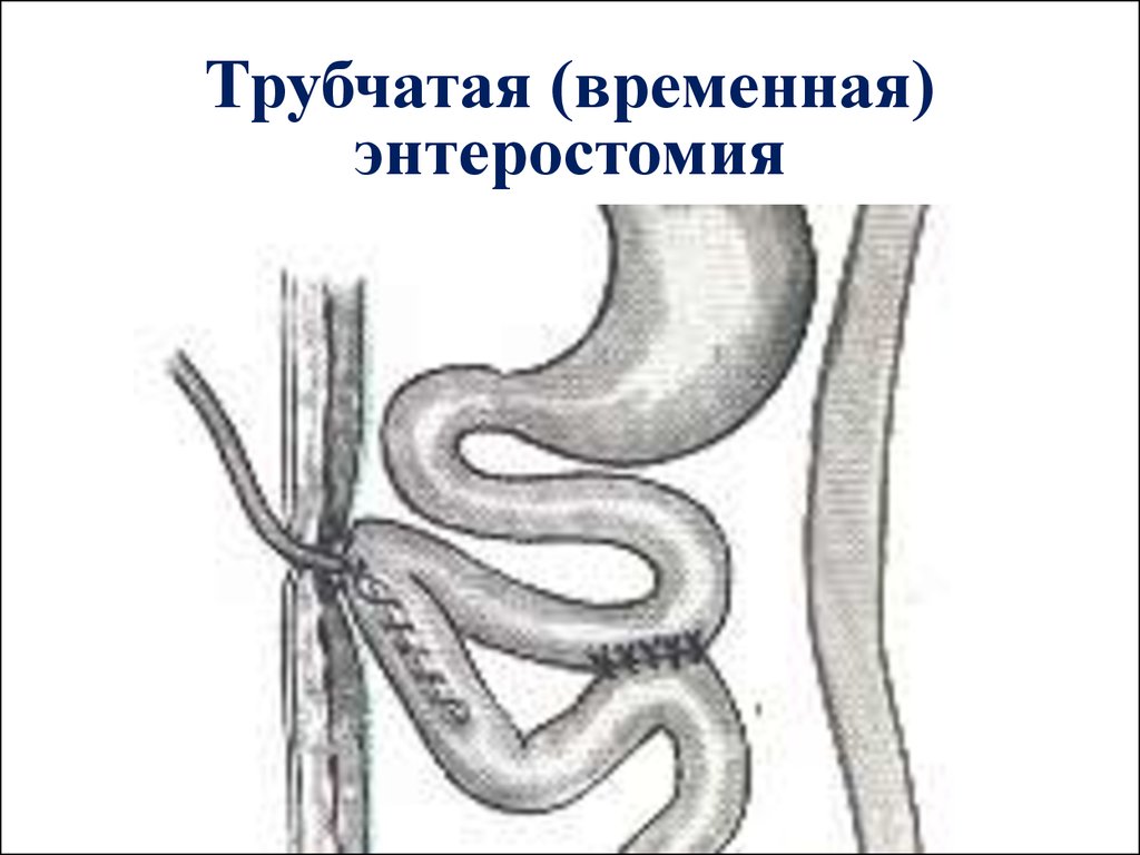 Энтеростома. Еюностома по Майдлю техника. Энтеростомия топографическая анатомия.