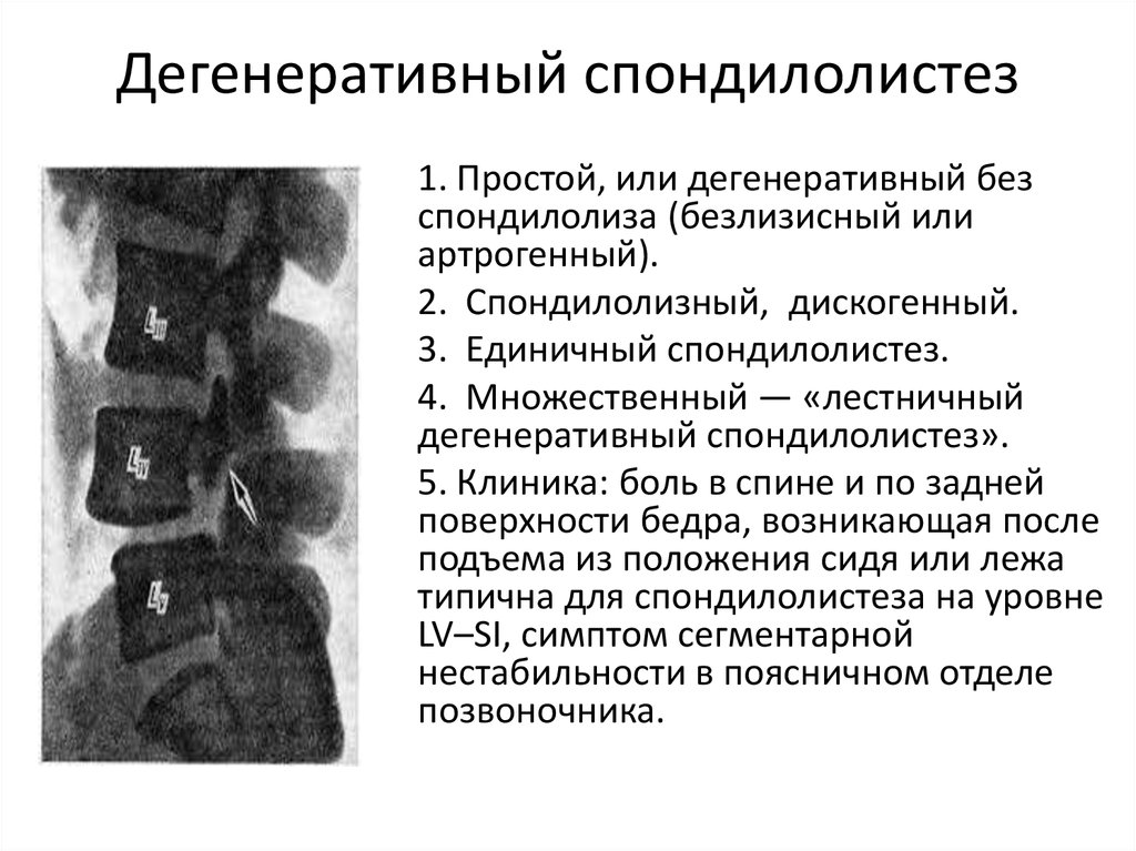 Что значит дегенеративные изменения шейного отдела