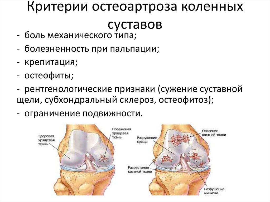 Болезненность при пальпации. Остеоартроз критерии. Памятка с остеоартрозом. Механическая боль при остеоартрозе.