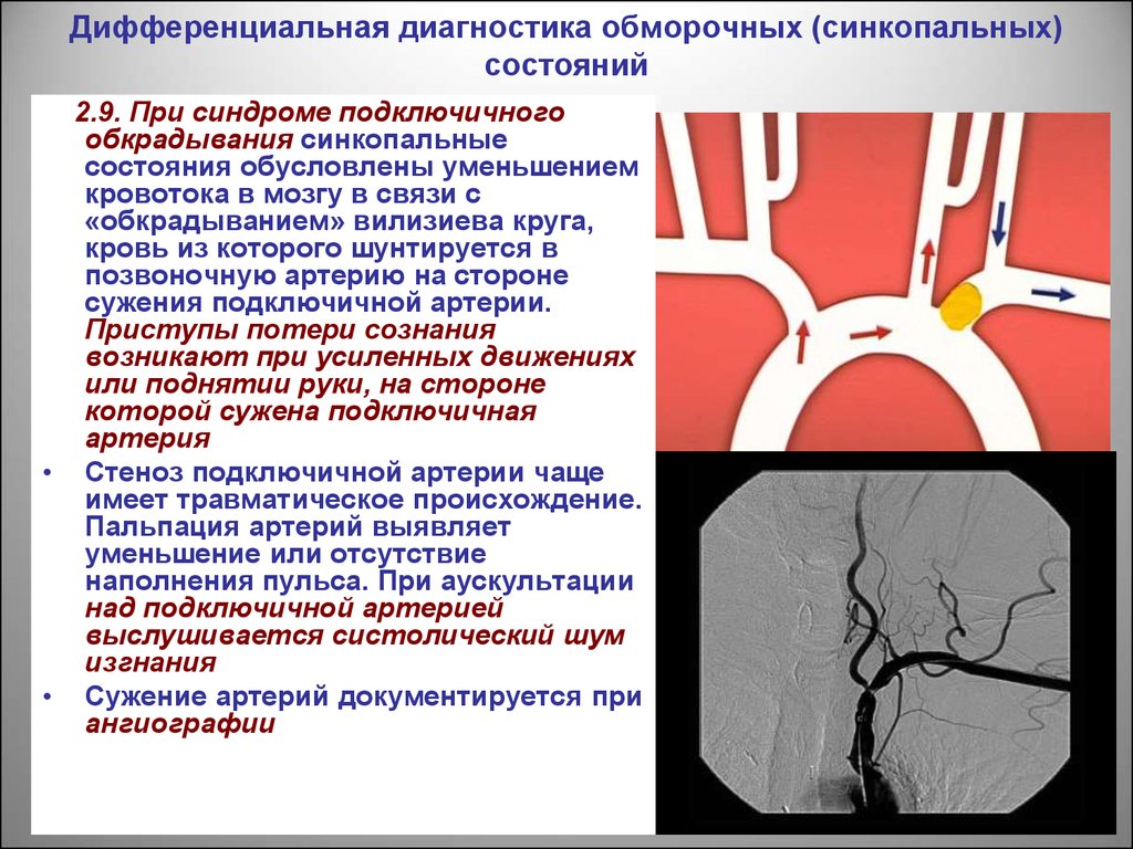 Стеноз подключичной. Стеноз подключичной артерии УЗИ. Синдром позвоночно подключичного обкрадывания на УЗИ. Вертебральный синдром позвоночной артерии. Симптом обкрадывания подключичной артерии.
