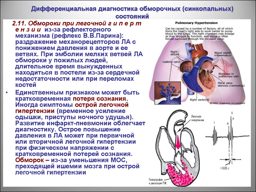 Диагноз легочной гипертензии. Дифференциальный диагноз легочной гипертензии. Дифференциальная диагностика при легочной гипертензии. Дифференциальный диагноз синкопальных состояний. Дифференциальный диагноз при синкопальных состояниях.